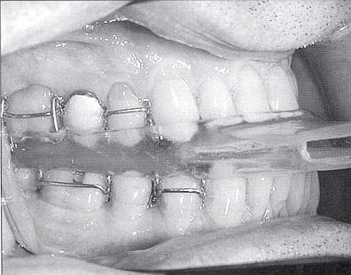 oral appliance2