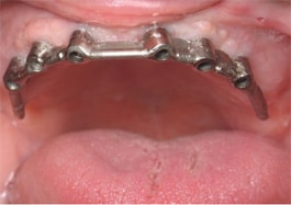 bar overdenture