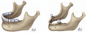 drawings of jaw bones with and without dental implant attached