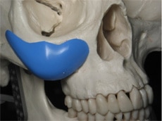 cheek implant