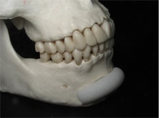 chin implant