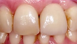 dental implant complete