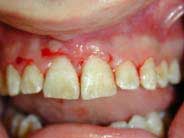 fractured central incisors