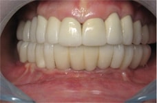 implant metal bridge