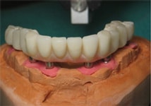 implant plastic bridge