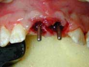 implants placed