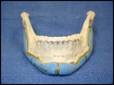 lower jaw implant2
