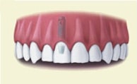 multiple single implants