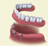 overdenture