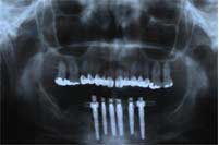 placed implants