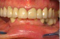preoperative occlusion