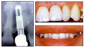single implant