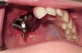 metal zygoma dental implant to restore part of mouth lost due to cancer