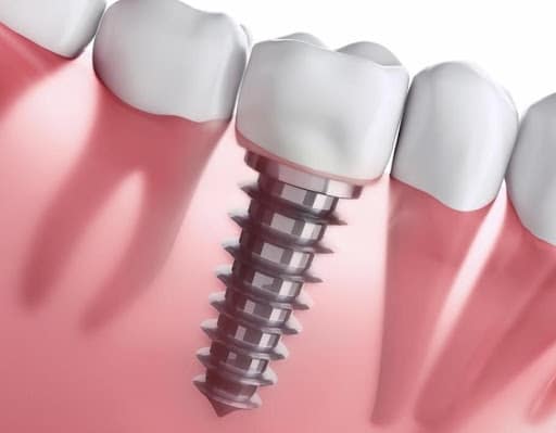 up close 3D-render of dental implant inside gum