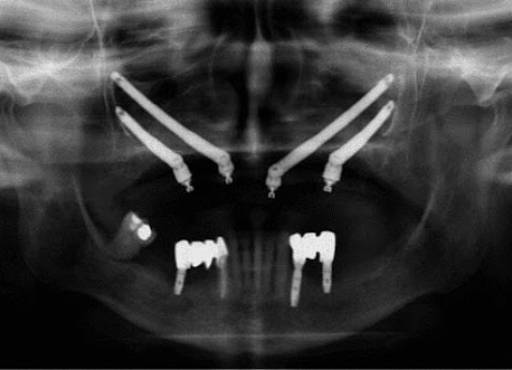 Quad Zygoma postop