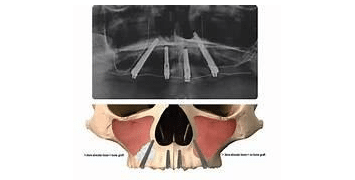 Trans-nasal Implant