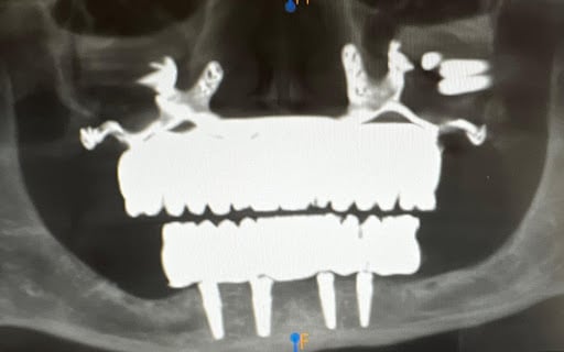 Postop 3D implant