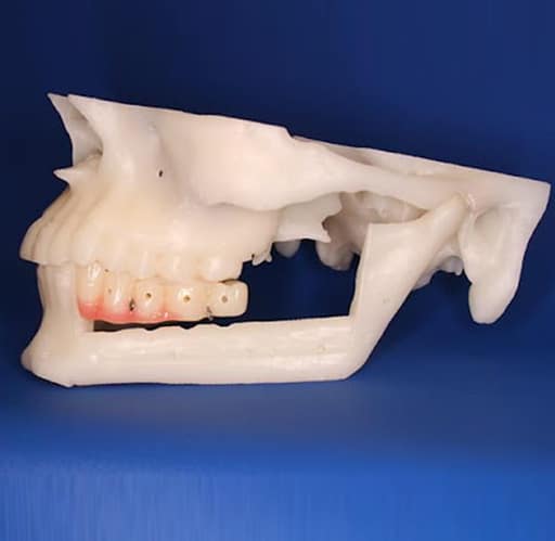 Development of implant retained prosthesis