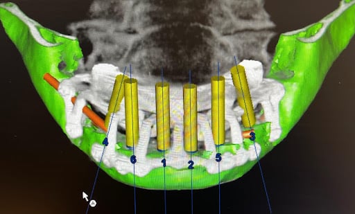 Virtual surgical plan