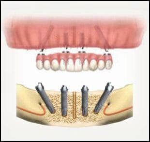 cross section illustration of jawbone with all on 4 dental implants placed