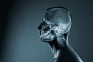 X-ray of man's head following a facial injury that needs reconstruction with help from an oral surgeon.