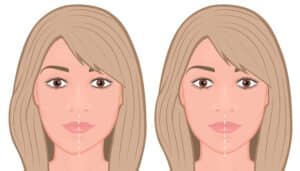 Illustrated depiction of a woman with an asymmetrical jaw and a symmetrical jaw following surgery for idiopathic condylar resorption.