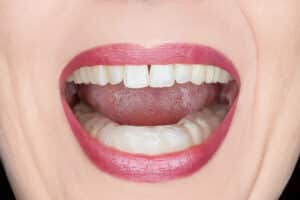 Woman opens her mouth with red lipstick to do jaw exercises after surgery.